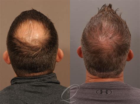 Hair Restoration photo
