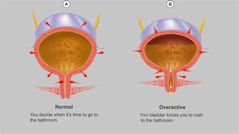 Incontinence & Overactive Bladder photo