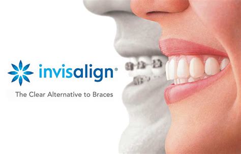Invisalign Clear Teeth Aligners