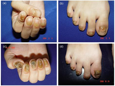 Psoriasis, Skin & Nails photo