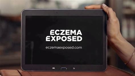 Sanofi Genzyme & Regeneron TV commercial - Eczema Exposed