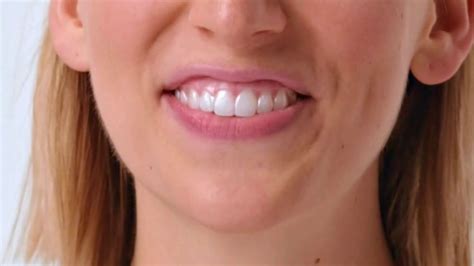 Smile Direct Club Aligner TV commercial - Works Simply: Less Than $3 a Day