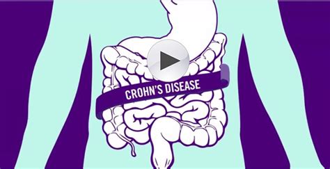 Stelara (Crohns Disease) TV commercial - ¡Basta!: $5 dólares por dosis